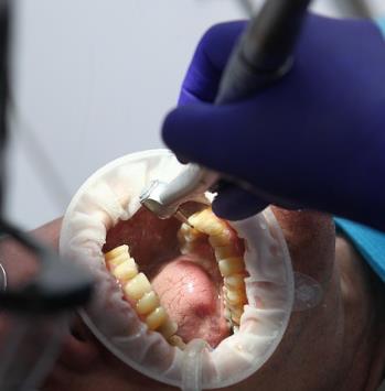 口腔微生物組：胰腺癌風(fēng)險(xiǎn)的新型生物標(biāo)志物